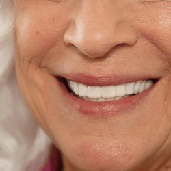 لمینت دندان دو فک مدل TruSmile به همراه نوار چسب سفیدکننده دندان